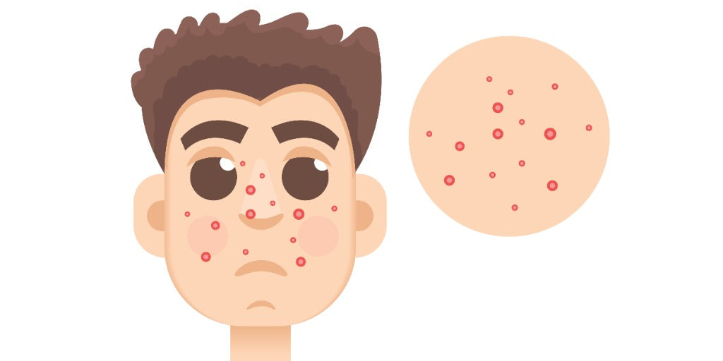 Understanding and Managing Acne: A Comprehensive Guide